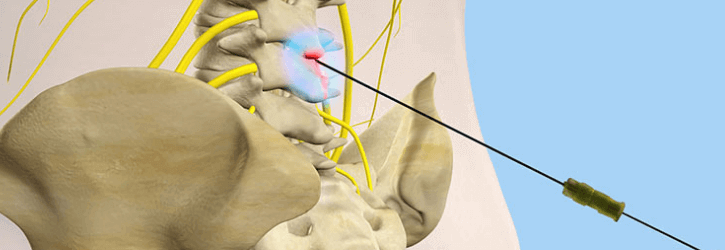 Sympathectomy for CRPS