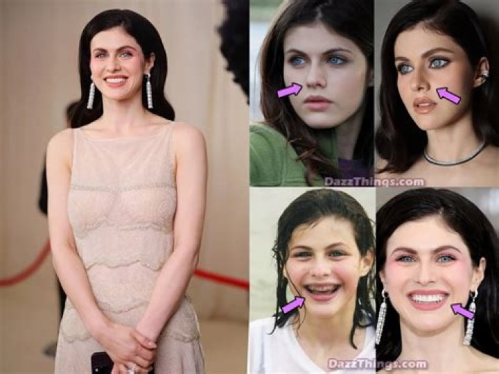 Alexandra Daddario's Plastic Surgery Journey Revealed