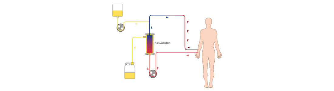 Plasma Exchange