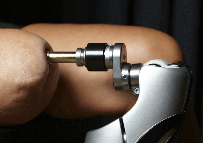 A new hope for CRPS amputees BLB Chronic Pain