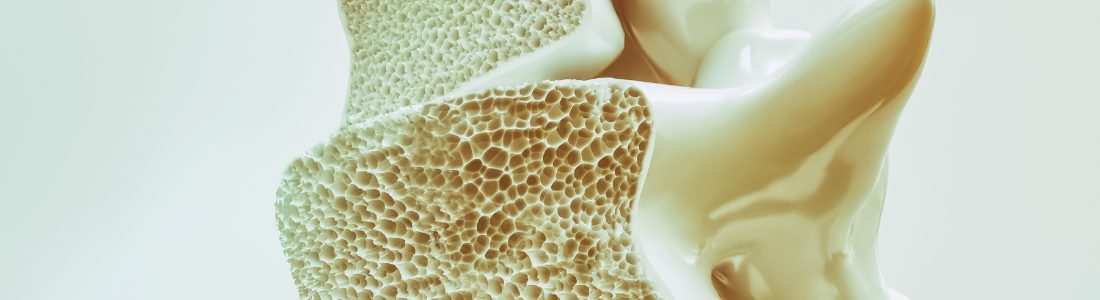 Osteoporosis