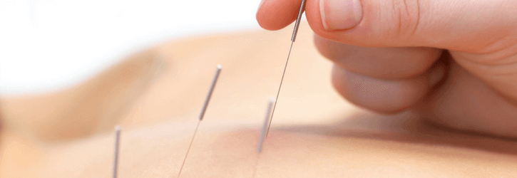 Dry Needling