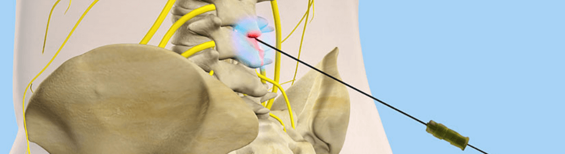 Sympathectomy