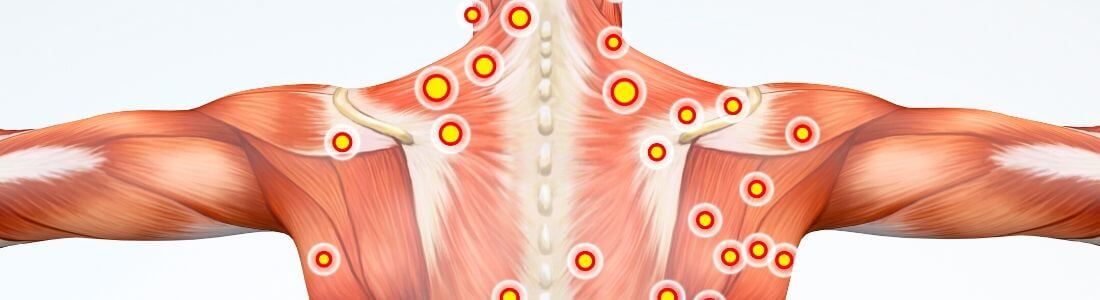 Myofascial Syndrome Trigger Points Chart