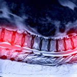 Spinal cord before SCS procedure