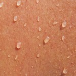 Person with CRPS sweating